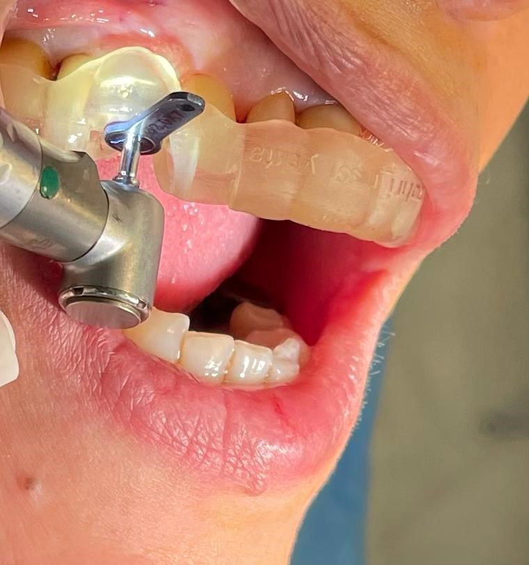 استفاده از لیزر در دندانپزشکی در مطب دکتر زهرا ظهری متخصص جراحی لثه و ایمپلنت و لیزر در دندانپزشکی