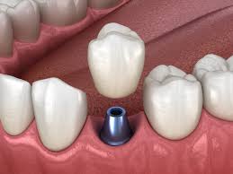 همه چیز درباره ایمپلنت توسط دکتر زهرا ظهری متخصص جراحی لثه و ایمپلنت و لیزر در دندانپزشکی